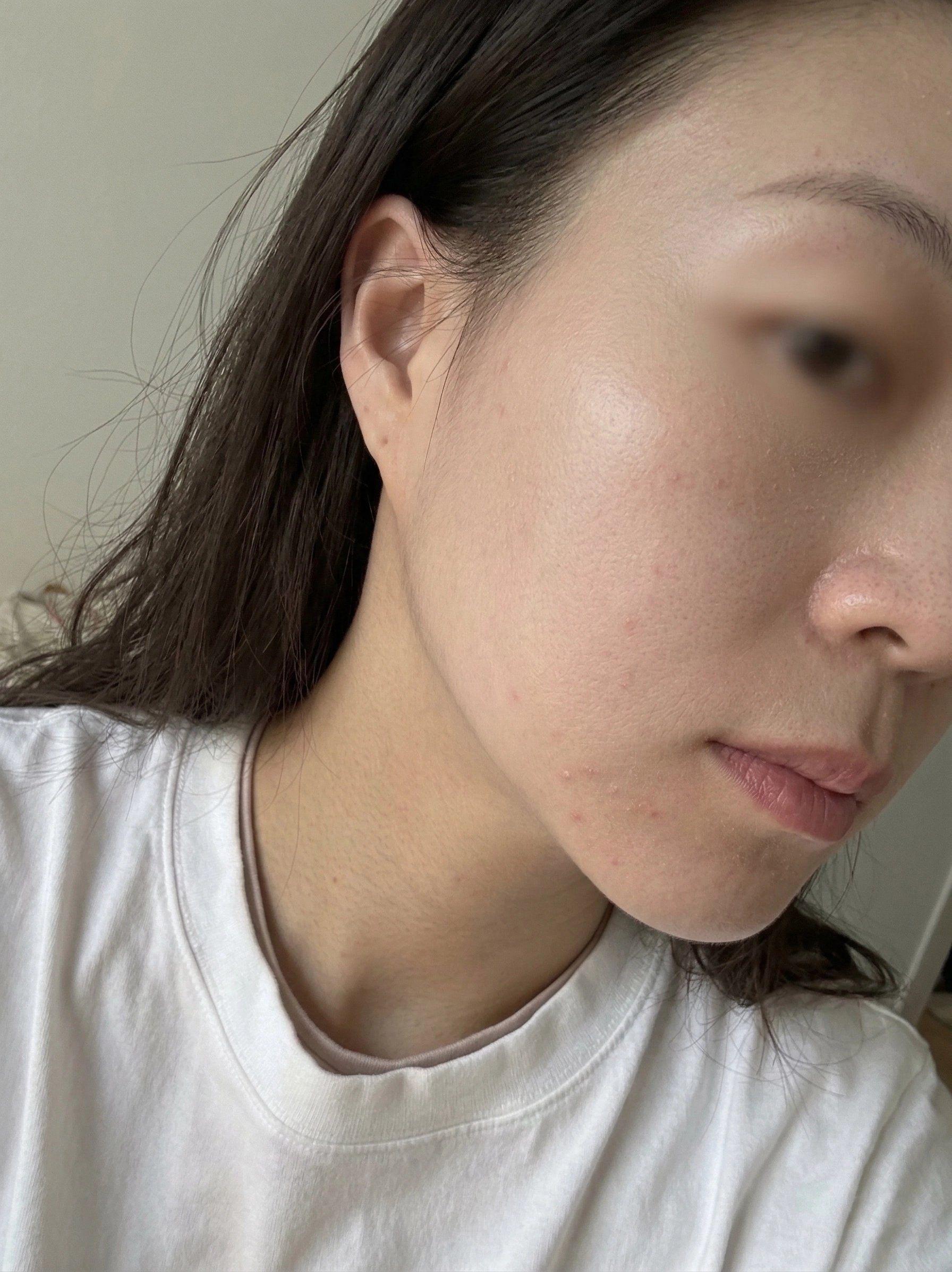 피부결 before 사진
